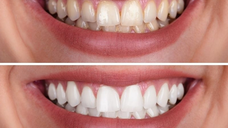 Zirkonyum Diş Kaplamaları ve Bakımı Hakkında Bilinmesi Gerekenler